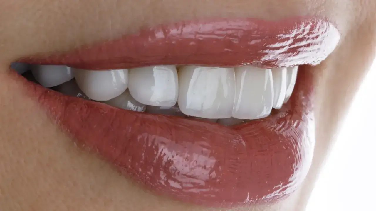 Licówki na zęby: Kompleksowy przewodnik. Czy to dla Ciebie?