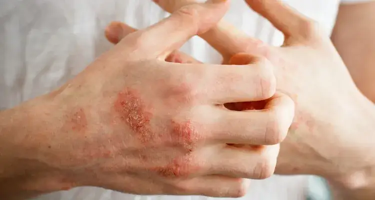 Alergia na gluten objawy skórne – jak je rozpoznać i leczyć