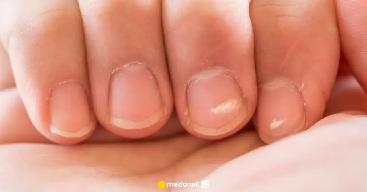 Białe plamy na paznokciach: Czy to tylko uraz czy brak witamin?