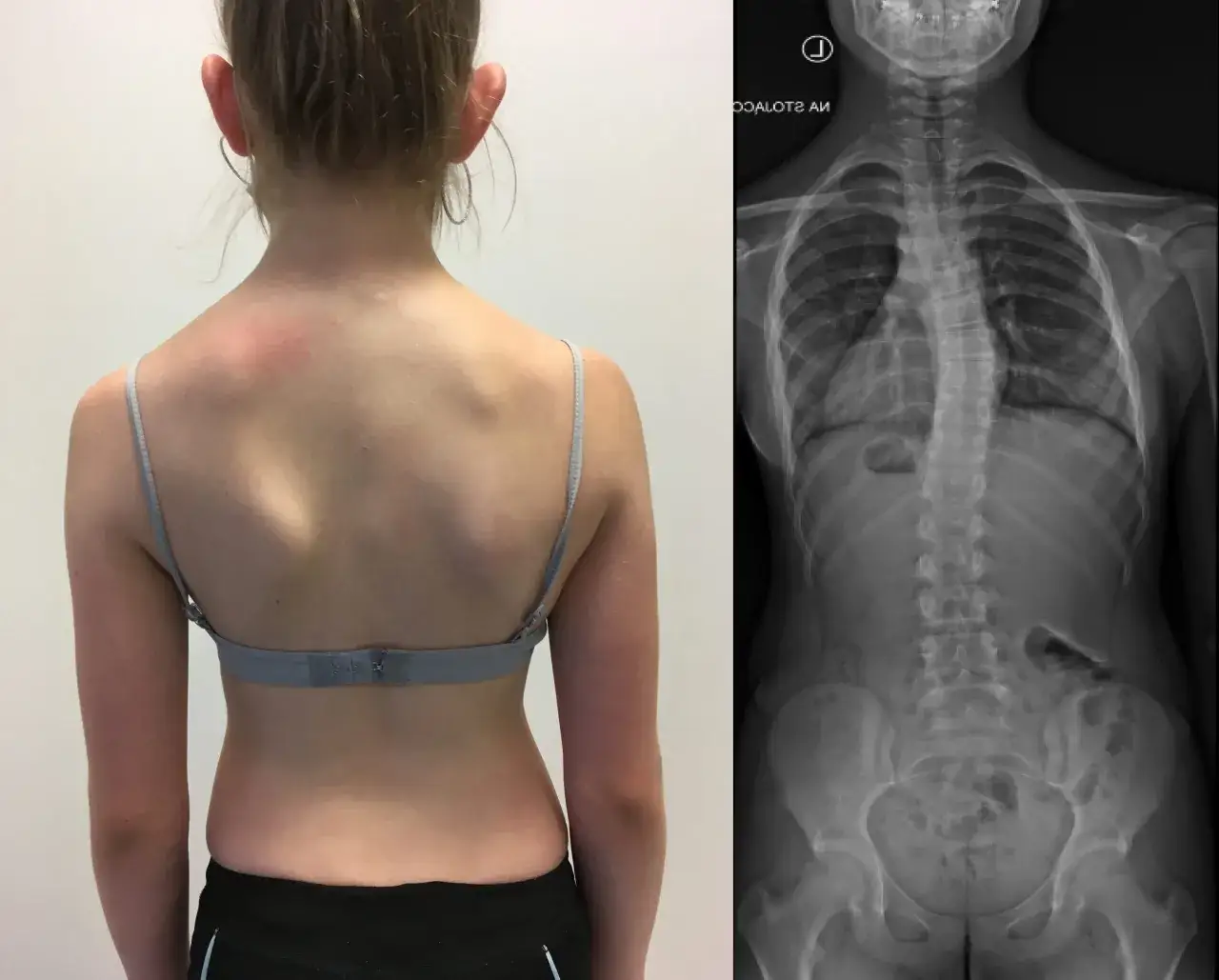 Skolioza: Jaki lekarz? Ortopeda i co dalej?