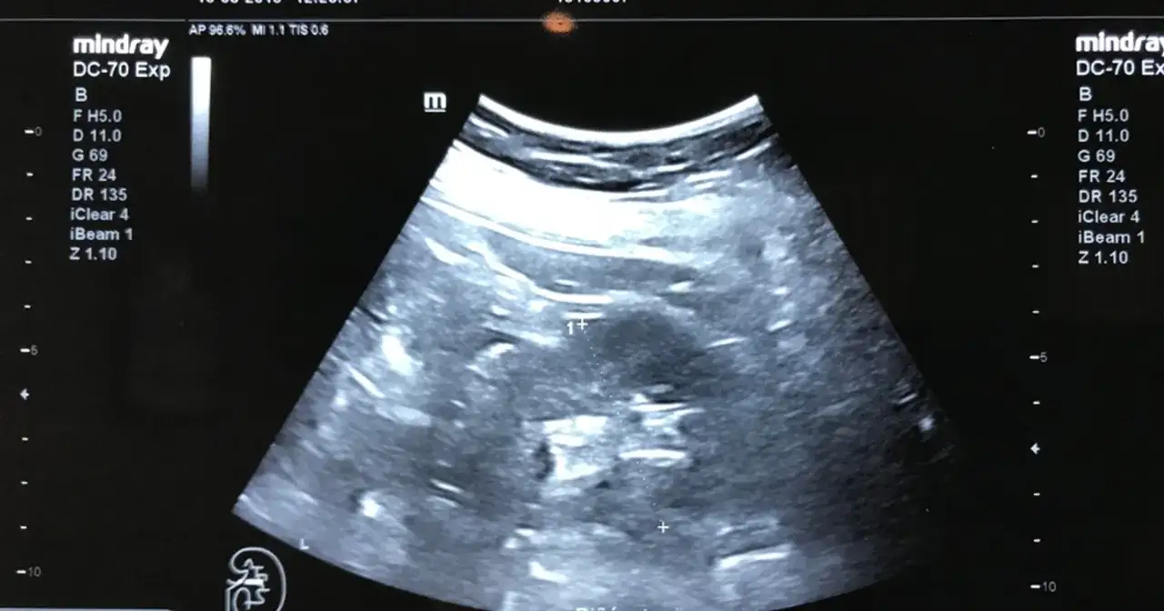 Obraz USG z widocznym zarodkiem, symbolizującym początki rozwoju medycyny prenatalnej, kiedy wynaleziono USG ciąży.