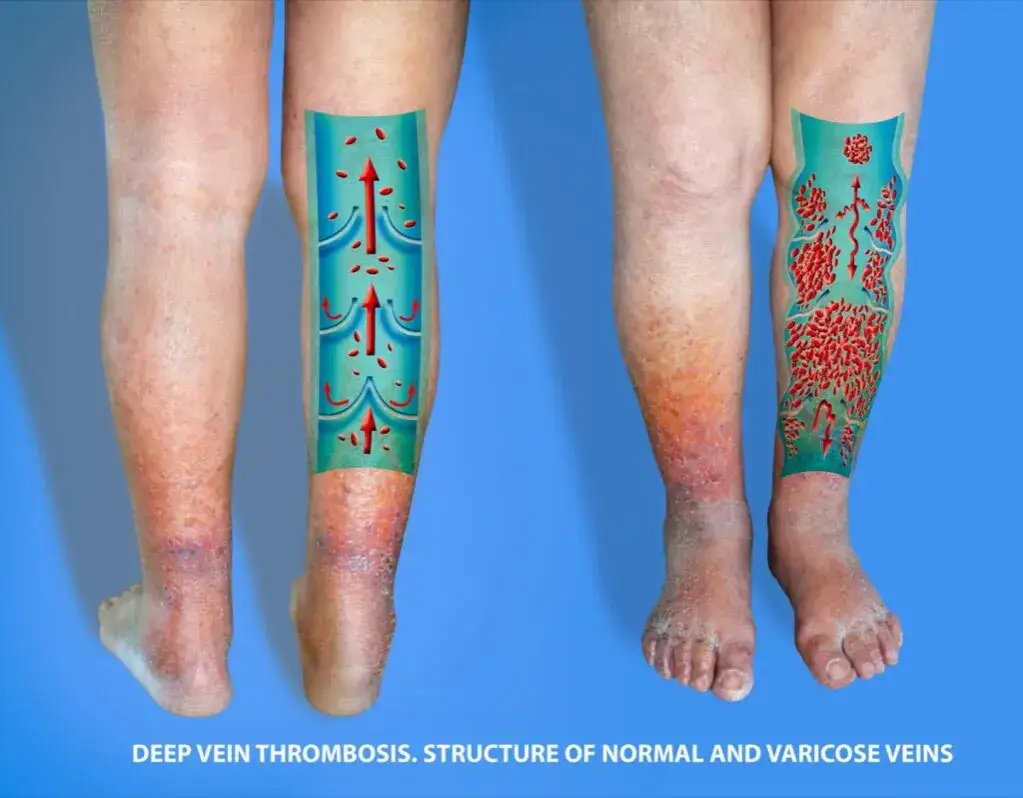 Zatoka jamista zakrzepica: poważne objawy i skutki, które musisz znać
