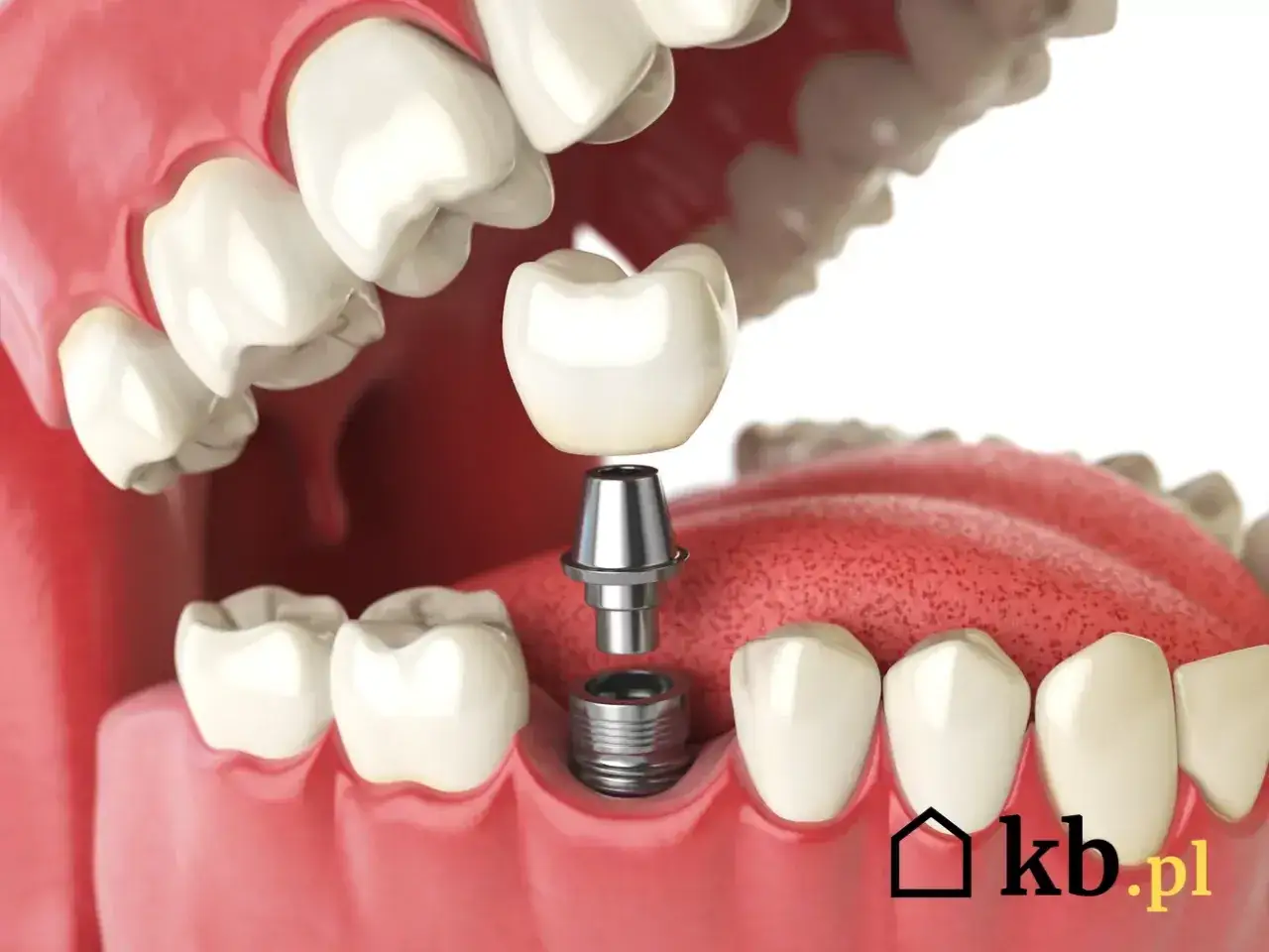 Ile kosztuje wstawienie zęba? Ceny implantów, mostów i protez 2024
