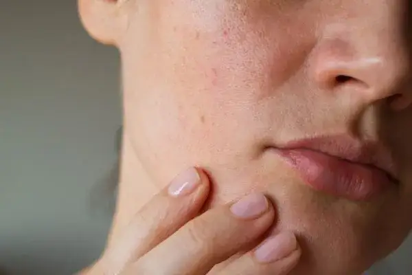 Jak pozbyć się pryszcza podskórnego - skuteczne metody i porady