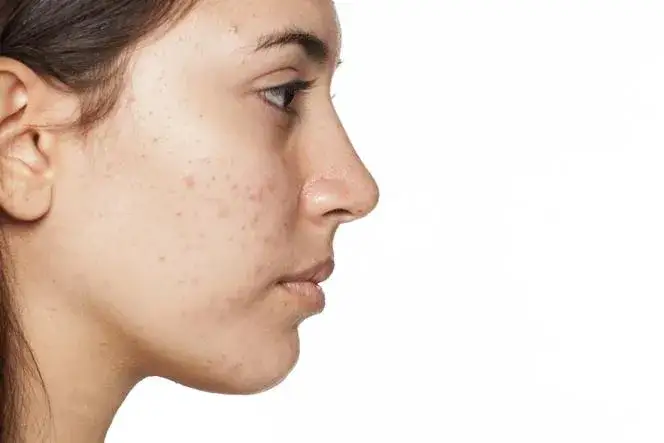 Zapchana cera jak wygląda - rozpoznaj objawy i uniknij problemów