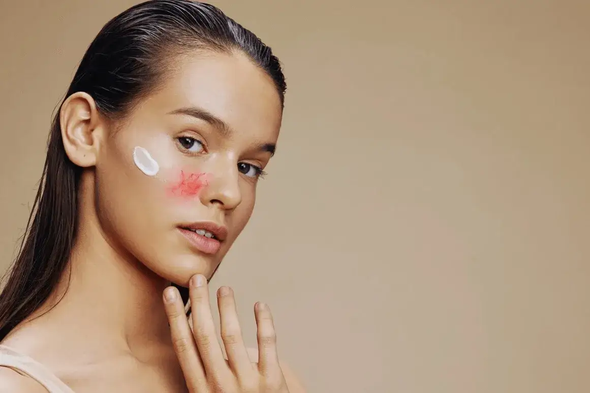 Cera naczynkowa: Czego unikać? Pielęgnacja, dieta, styl życia