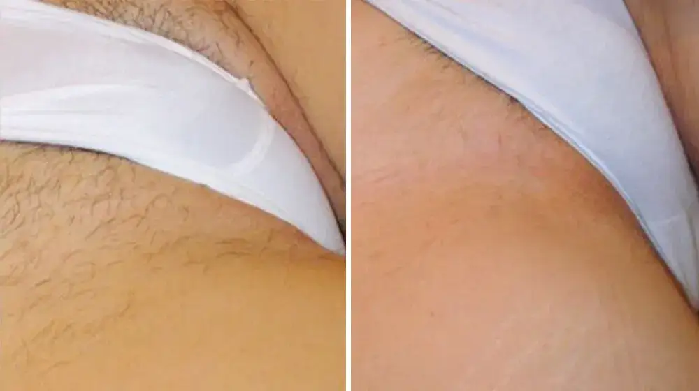 Ile zabiegów laserem na bikini potrzebujesz, by osiągnąć efekt?