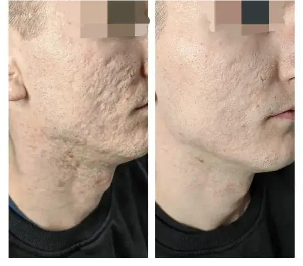 Kiedy można myć twarz po laserze frakcyjnym, aby uniknąć problemów?