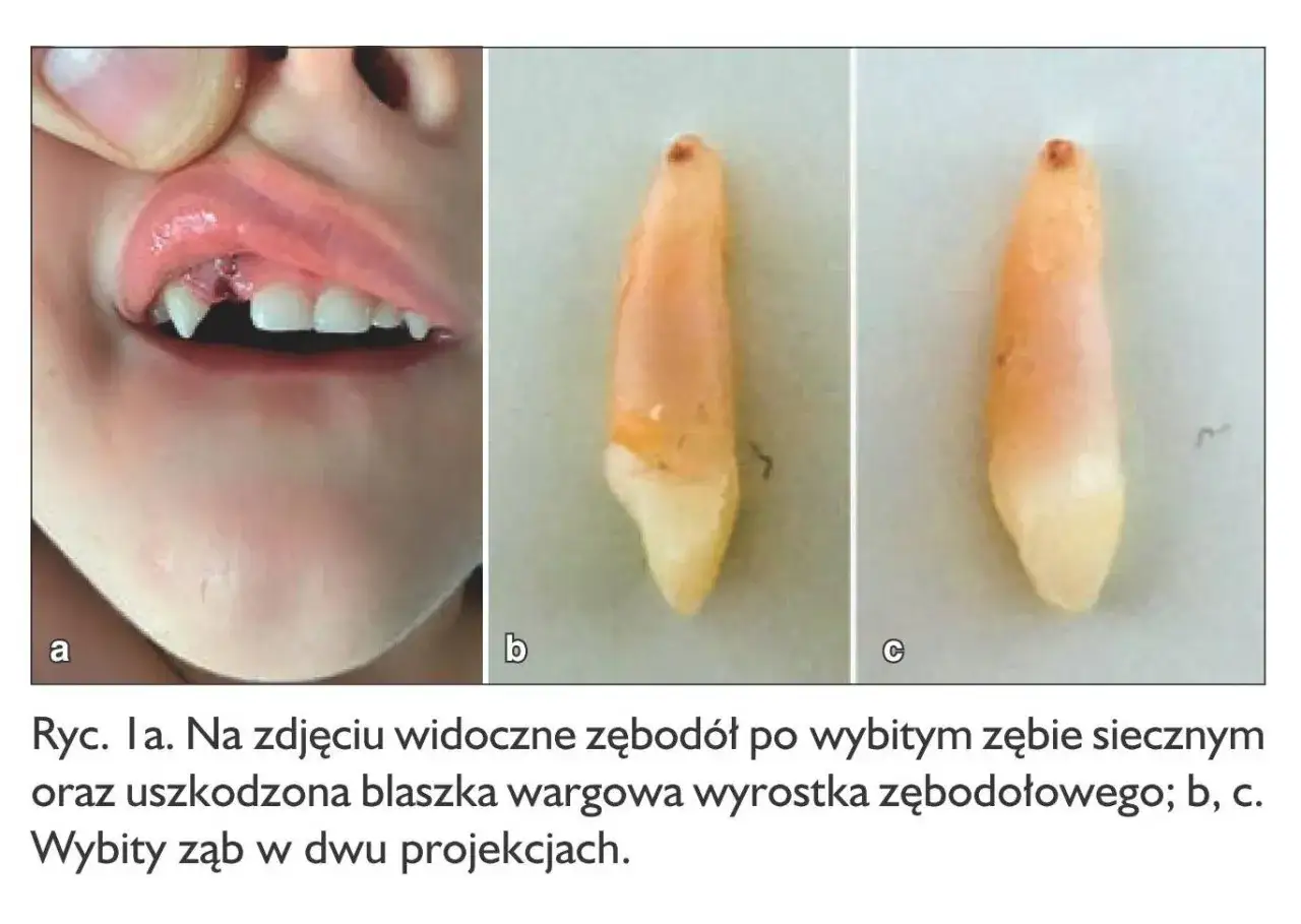 Dziecko z uszkodzonym zębodołem po wybitym zębie mlecznym. Widoczny ruszający się ząb mleczny po uderzeniu.