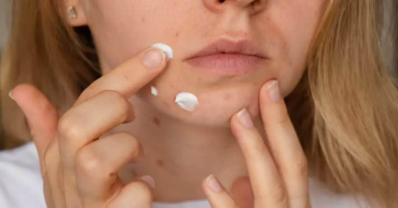 Co na pryszcze na twarzy? Sprawdzone metody i rady dermatologa.