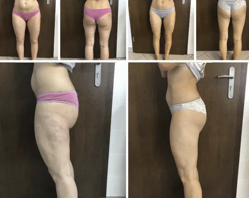 Endermologia: Czym jest? Jak działa? Efekty i wskazania