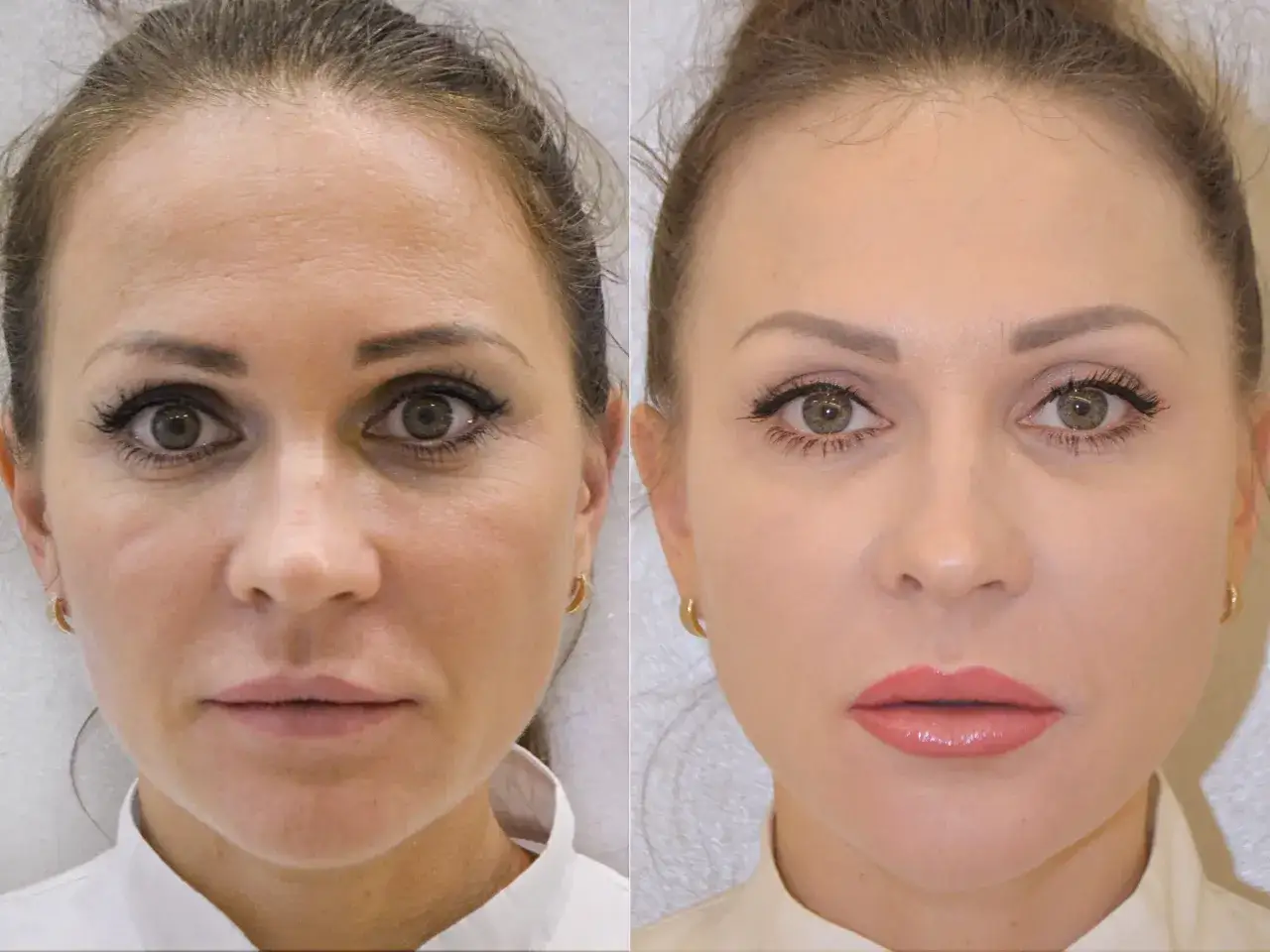 Kwas hialuronowy: Sekret nawilżenia i młodej skóry? Sprawdź!