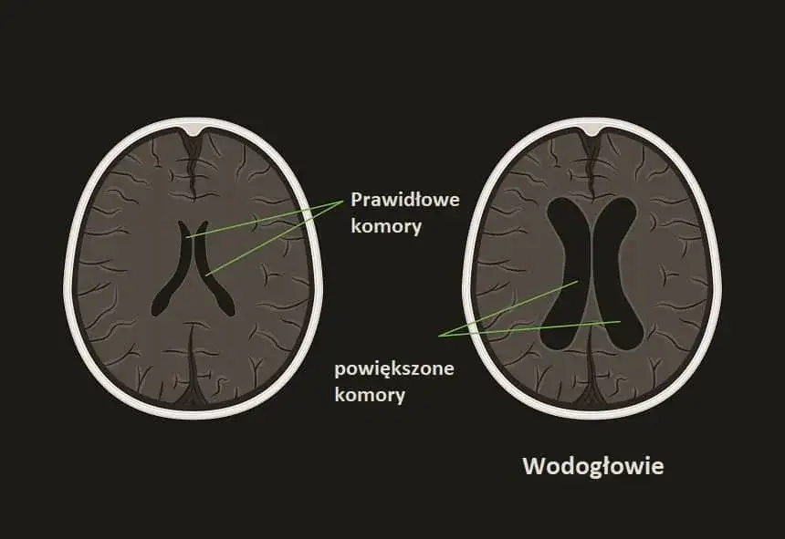 Wodogłowie u niemowląt: objawy, leczenie i co robić, gdy podejrzewasz?