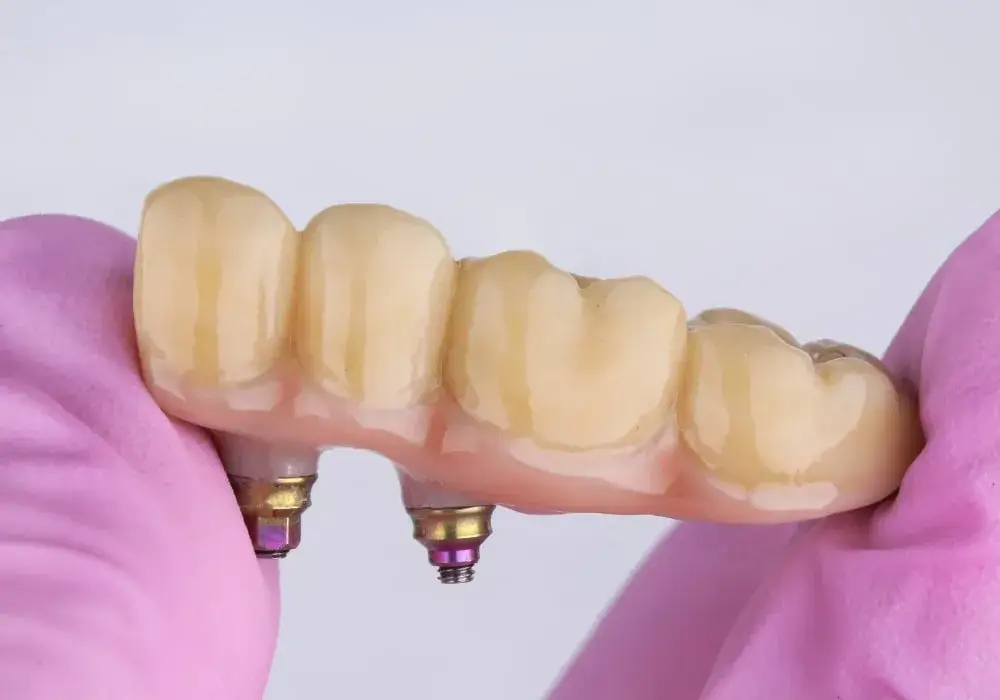 Most protetyczny: Jak wygląda? Estetyka i naturalny uśmiech krok po kroku