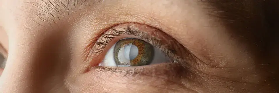 Początkowe objawy jaskry – jak je rozpoznać i uniknąć utraty wzroku