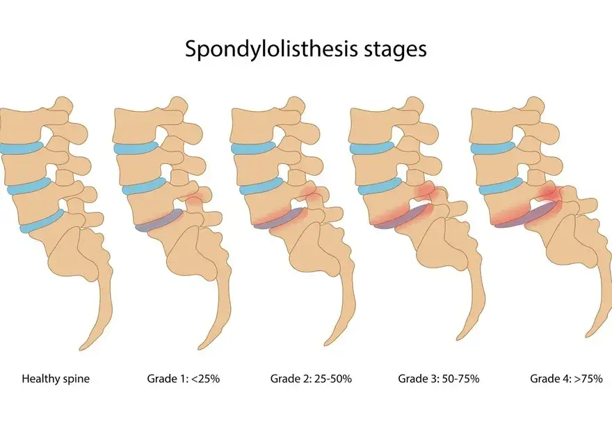 Co oznacza kręgozmyk 8mm i jak podejść do leczenia?