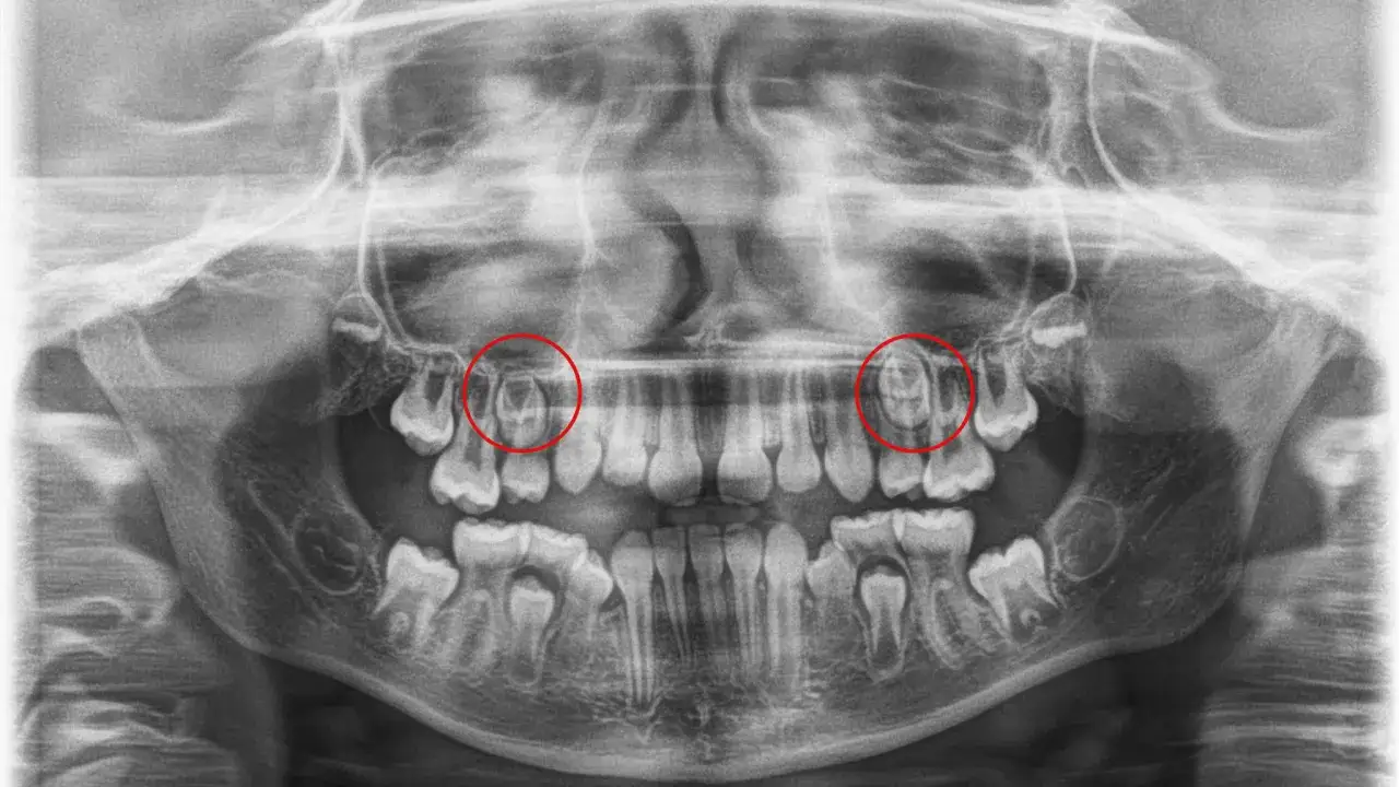 Czy pantomogram jest na NFZ? Sprawdź, co musisz wiedzieć o refundacji
