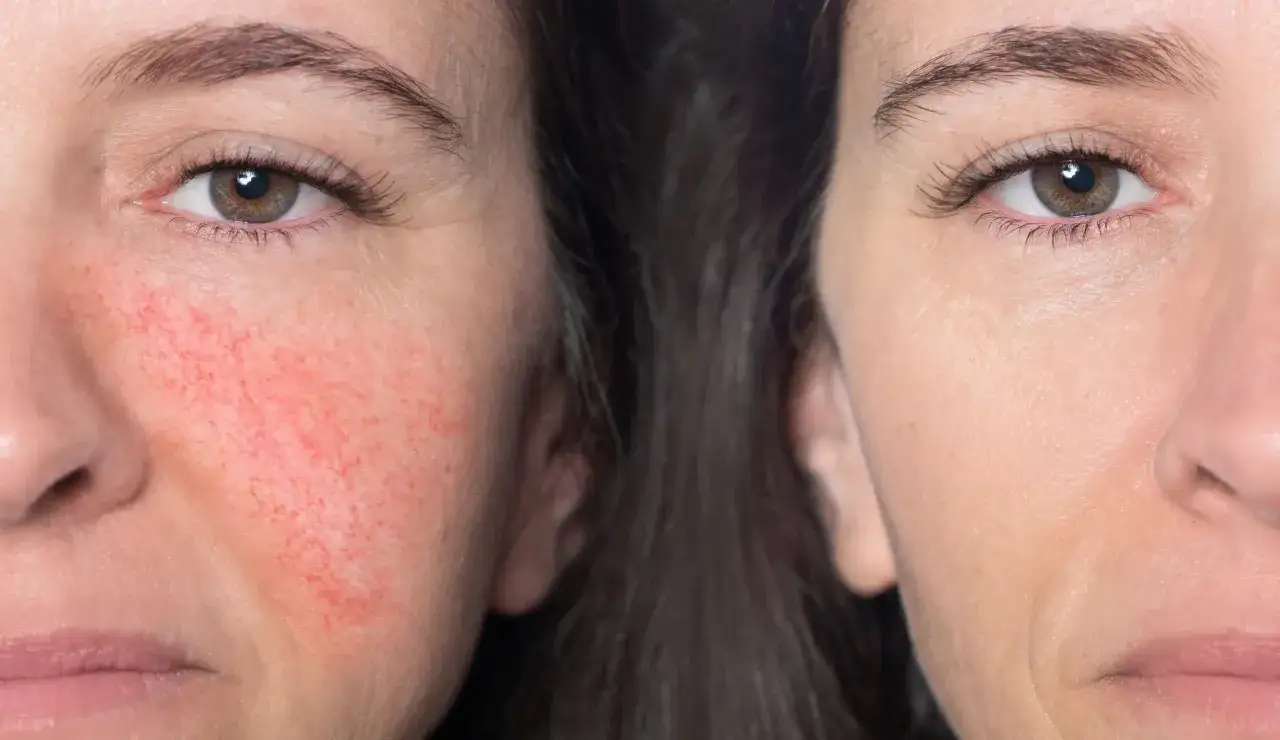 Cera naczynkowa: Jak się pozbyć pajączków? Skuteczne metody