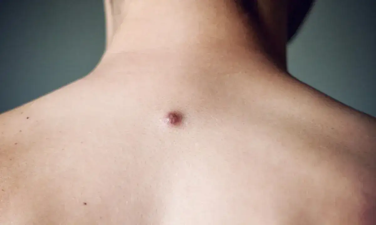 Pryszcz? Czym posmarować, by zniknął bez śladu i blizn