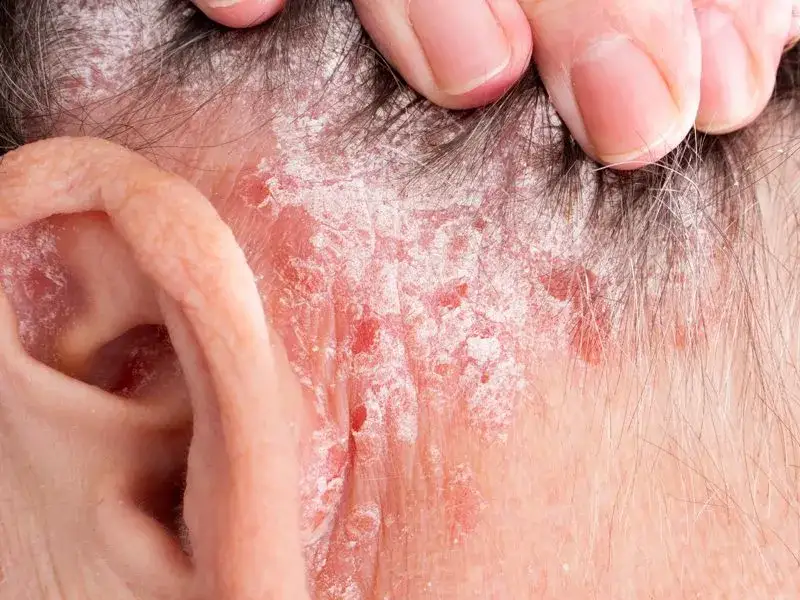 Co to jest łuszczyca i jak z nią postępować, by złagodzić objawy