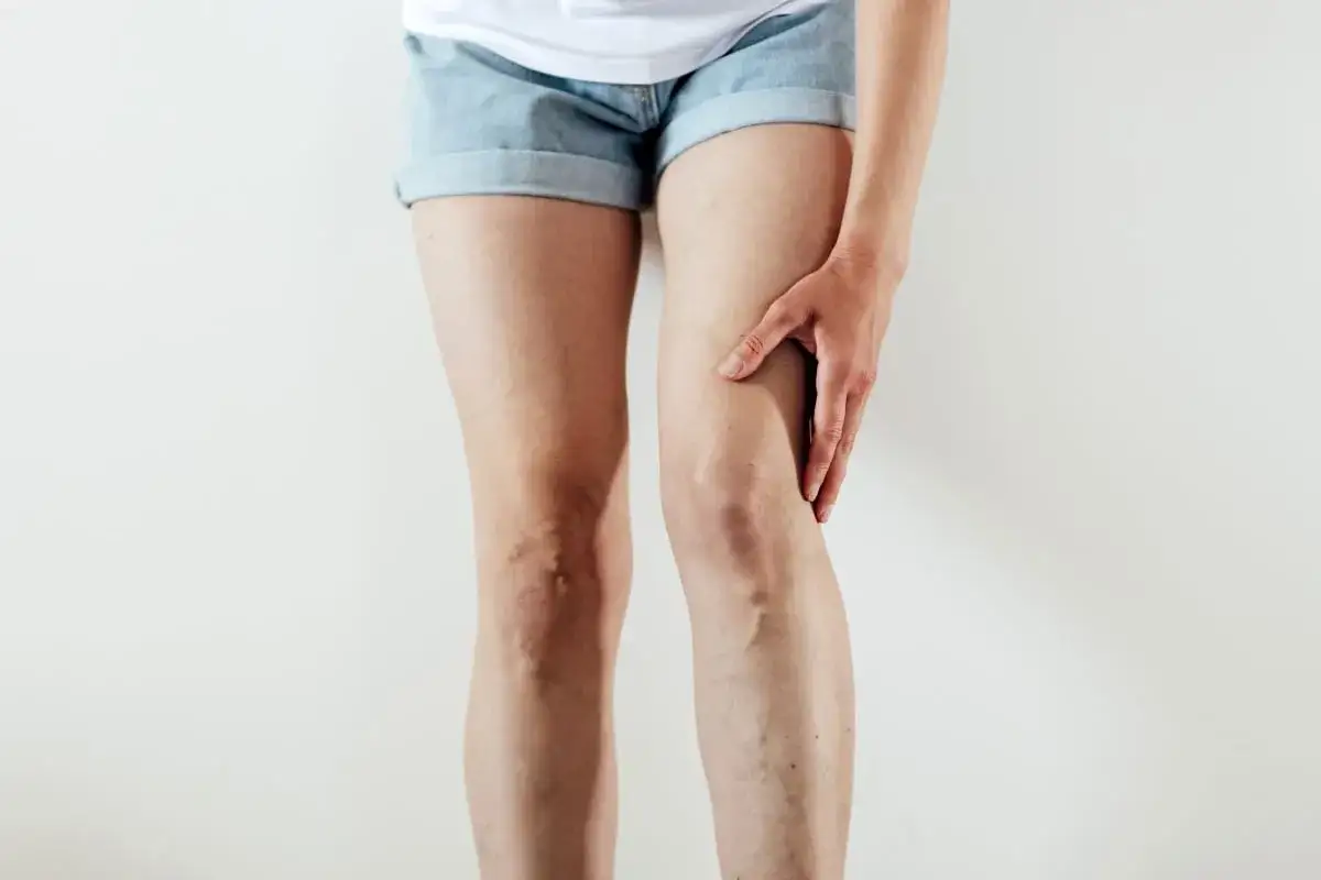 Zatrzymanie wody: leki, zioła, dieta. Kiedy do lekarza?