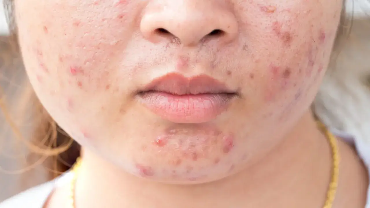 Trądzik różowaty: Skuteczna pielęgnacja i leczenie. Jak uspokoić cerę?