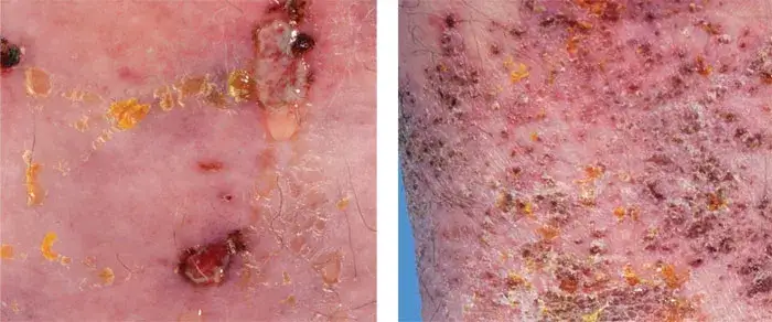 Skuteczne leczenie liszajca zakaźnego - sposoby na szybkie pozbycie się zmian