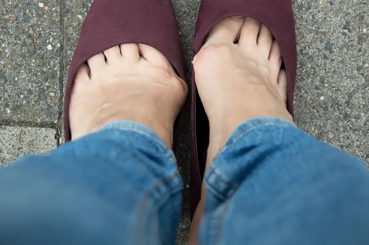 Rehabilitacja po operacji haluksa: plan ćwiczeń i powrót do sprawności