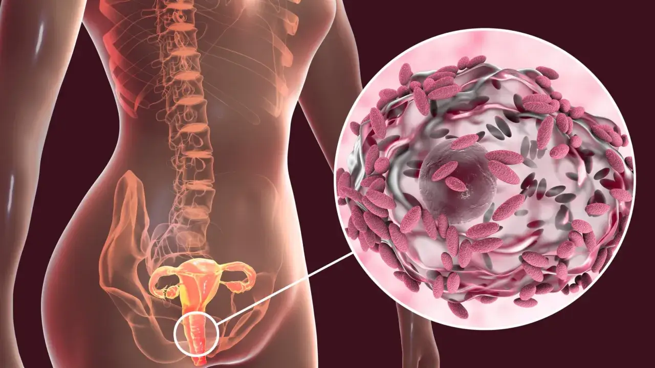 Anatomía femenina con detalle ampliado de vaginosis bacteriana.