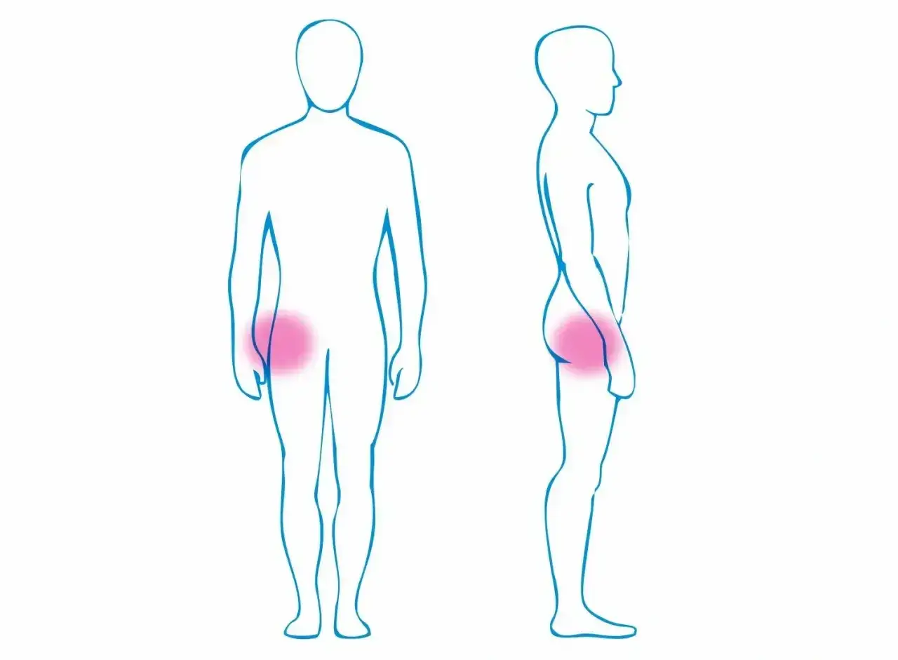 Ilustracja sylwetek ludzi z zaznaczonym na różowo bólem w okolicy bioder.