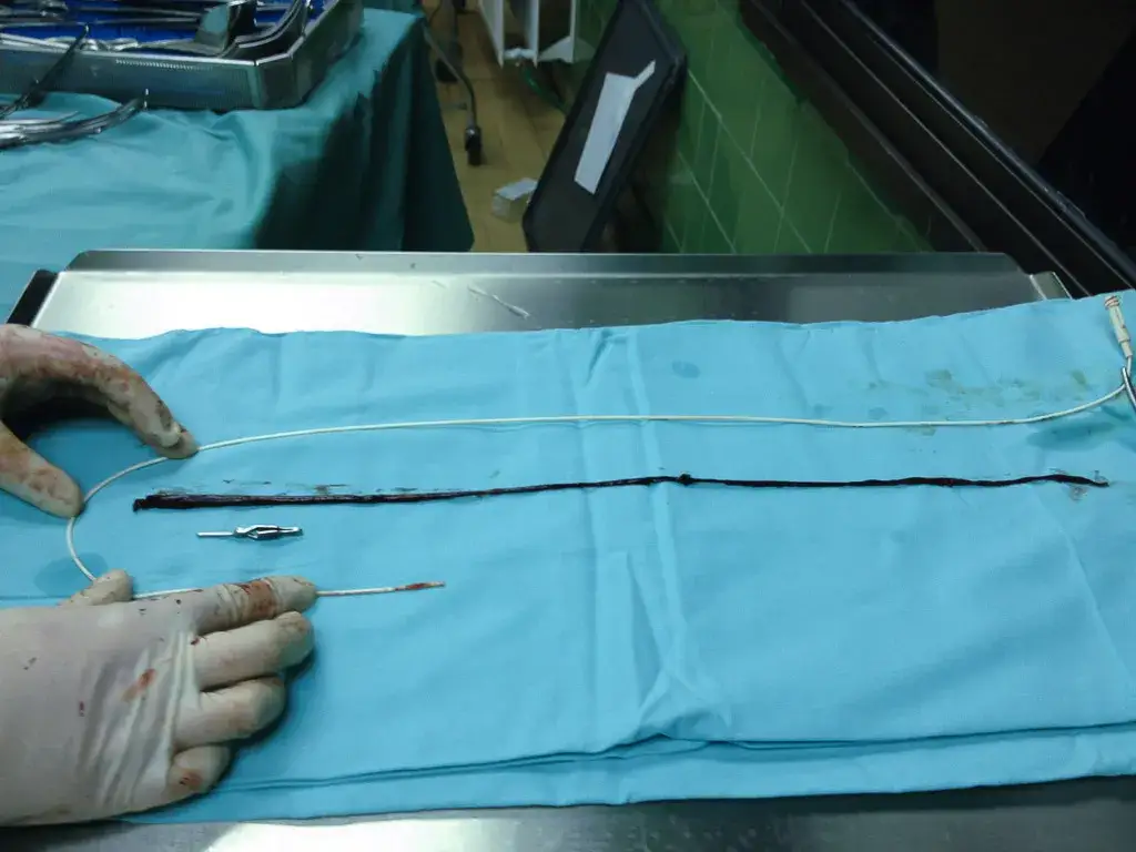 Zator tętnicy udowej objawy: jak nie przegapić groźnych sygnałów