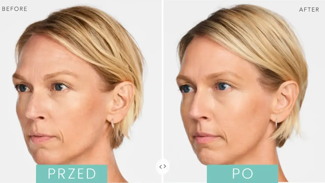 Radiesse czy kwas hialuronowy - porównanie skuteczności i zastosowania