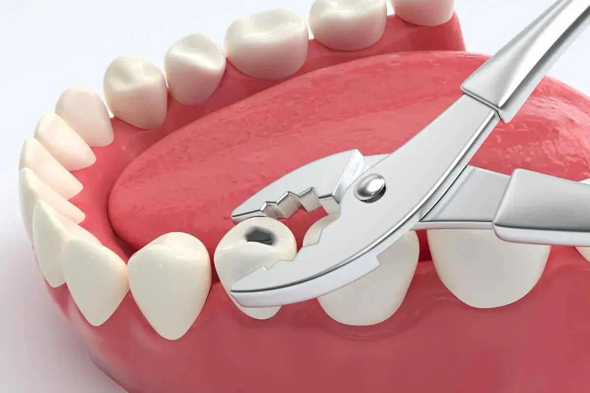 Chirurgiczne kleszcze dentystyczne chwytają ząb w jamie ustnej.