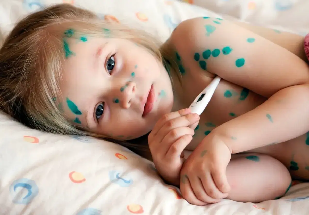 Ospa w przedszkolu co robić: kluczowe kroki dla rodziców