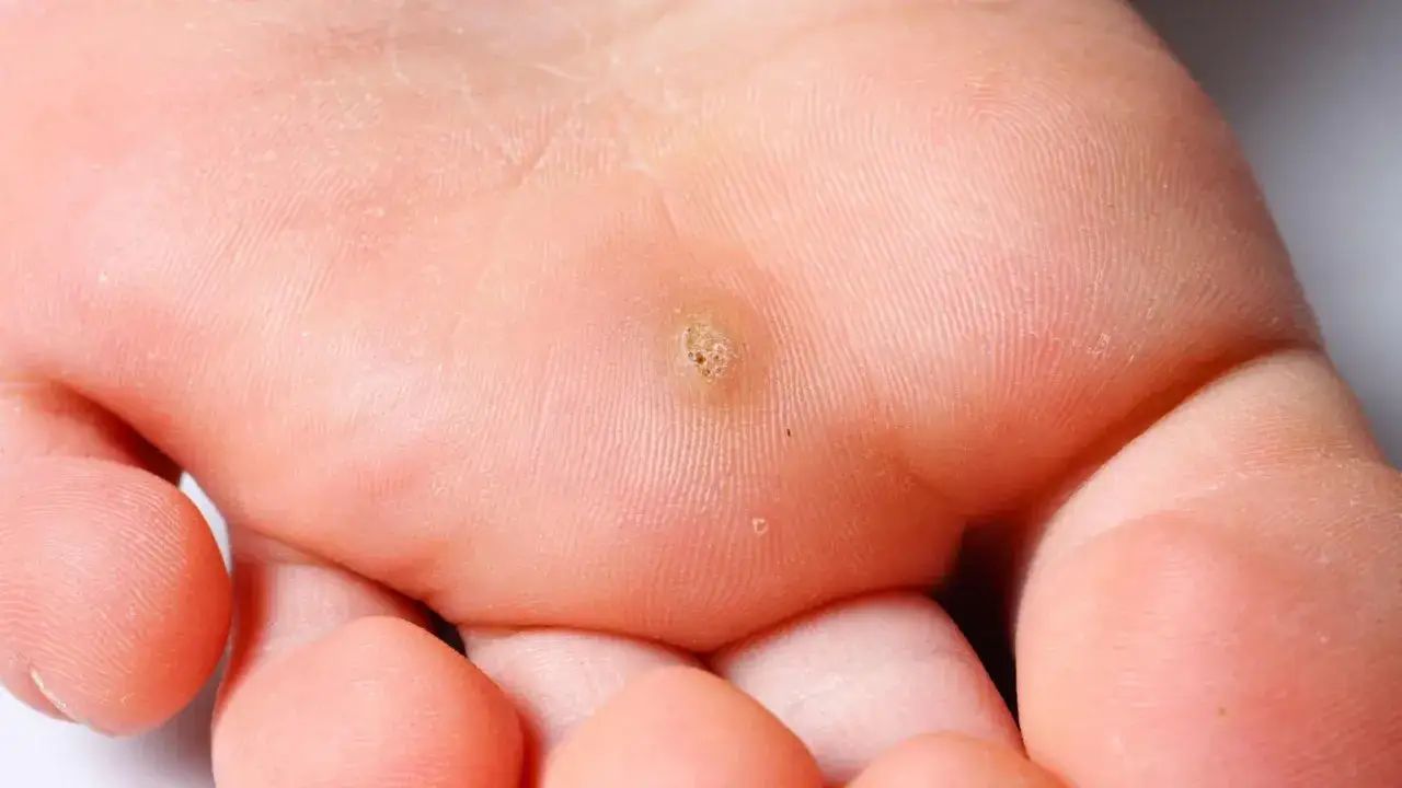 Widoczne modzele na dłoniach, z charakterystycznym, chropowatym zgrubieniem skóry w centrum.