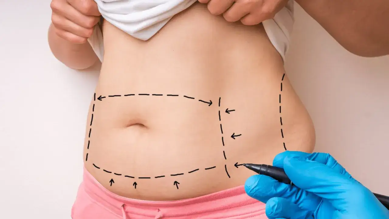 Liposukcja: Odkryj prawdę o odsysaniu tłuszczu. Co musisz wiedzieć?