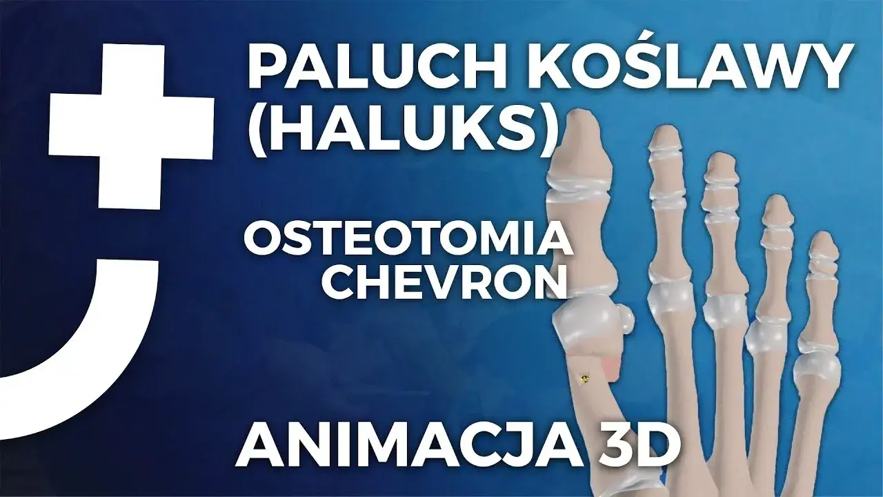 Gdzie operować haluksy na NFZ? Sprawdź dostępne placówki i terminy