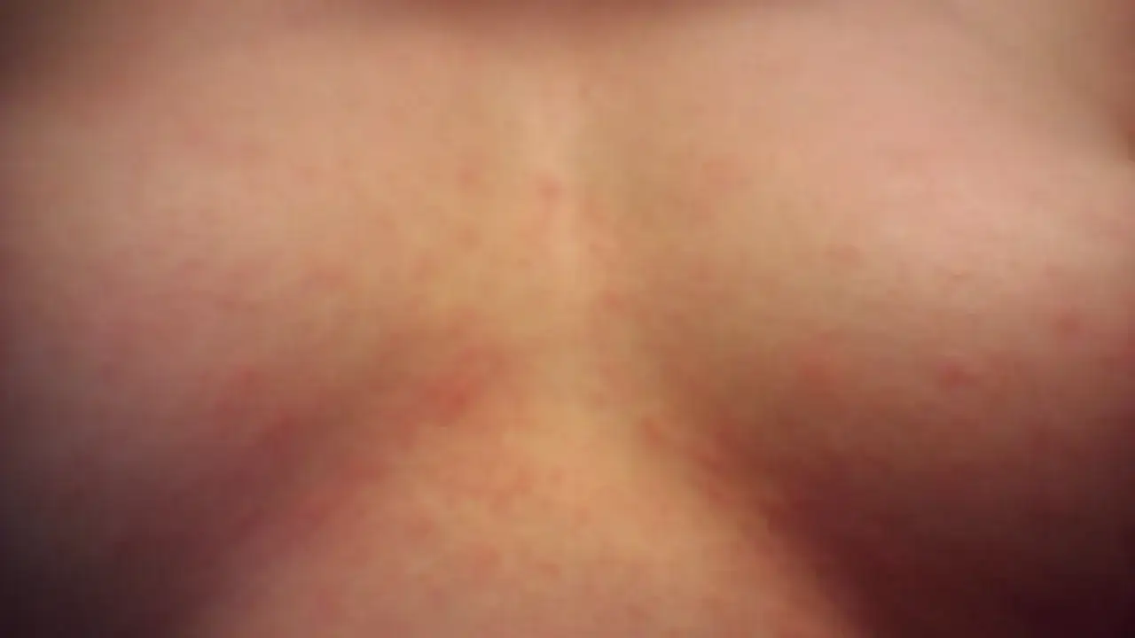 Wysypka między piersiami objawy: co może oznaczać i jak leczyć