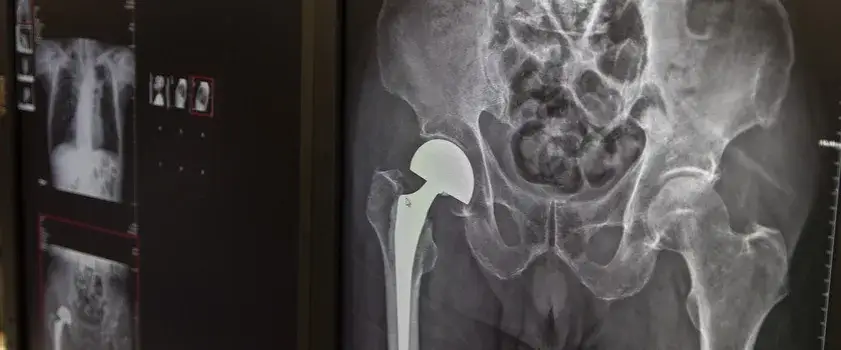 Wszystkie endoprotezy stawu biodrowego refundowane przez NFZ w 2025 roku