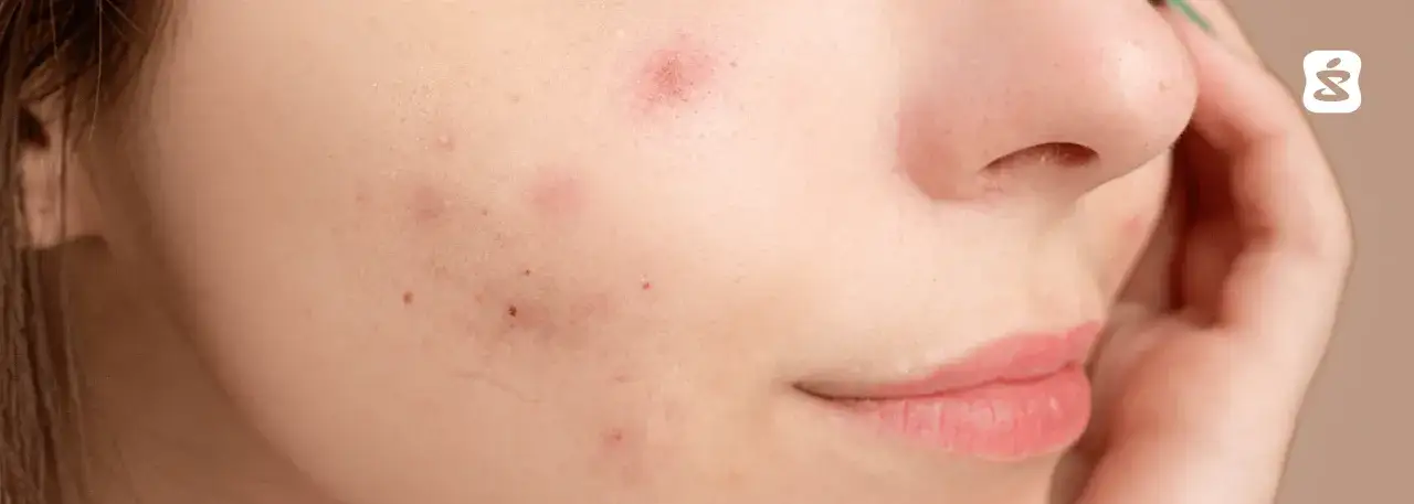 Szybkie sposoby na pryszcza: Co działa, a czego unikać?