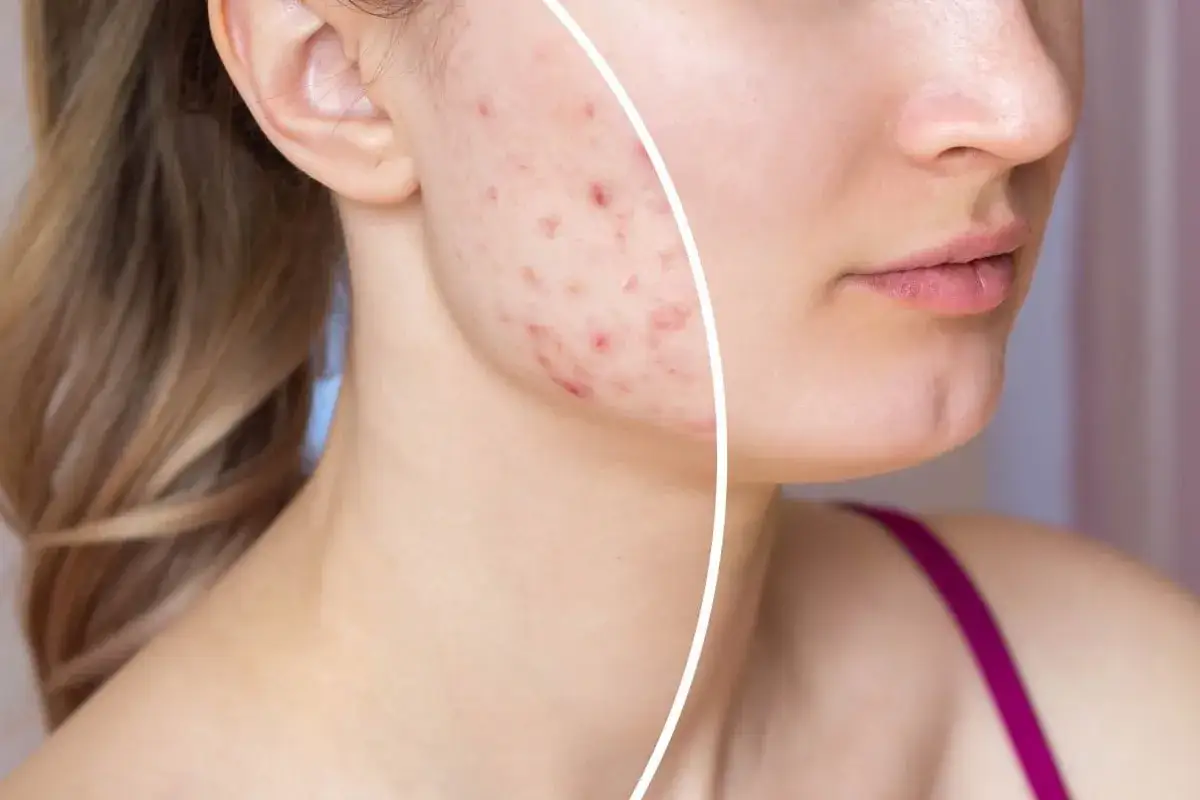 Trądzik młodzieńczy: Jak skutecznie walczyć z pryszczami? Poradnik