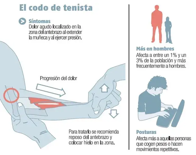 Codo de tenista: Síntomas clave, causas y alivio efectivo ¿Lo sufres?