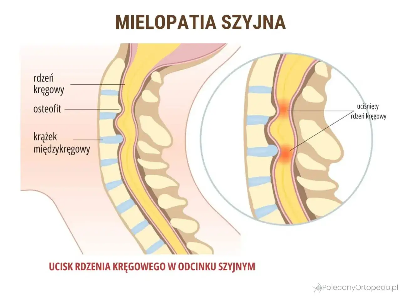 Objawy neurologiczne kręgosłupa szyjnego: kiedy to poważne?