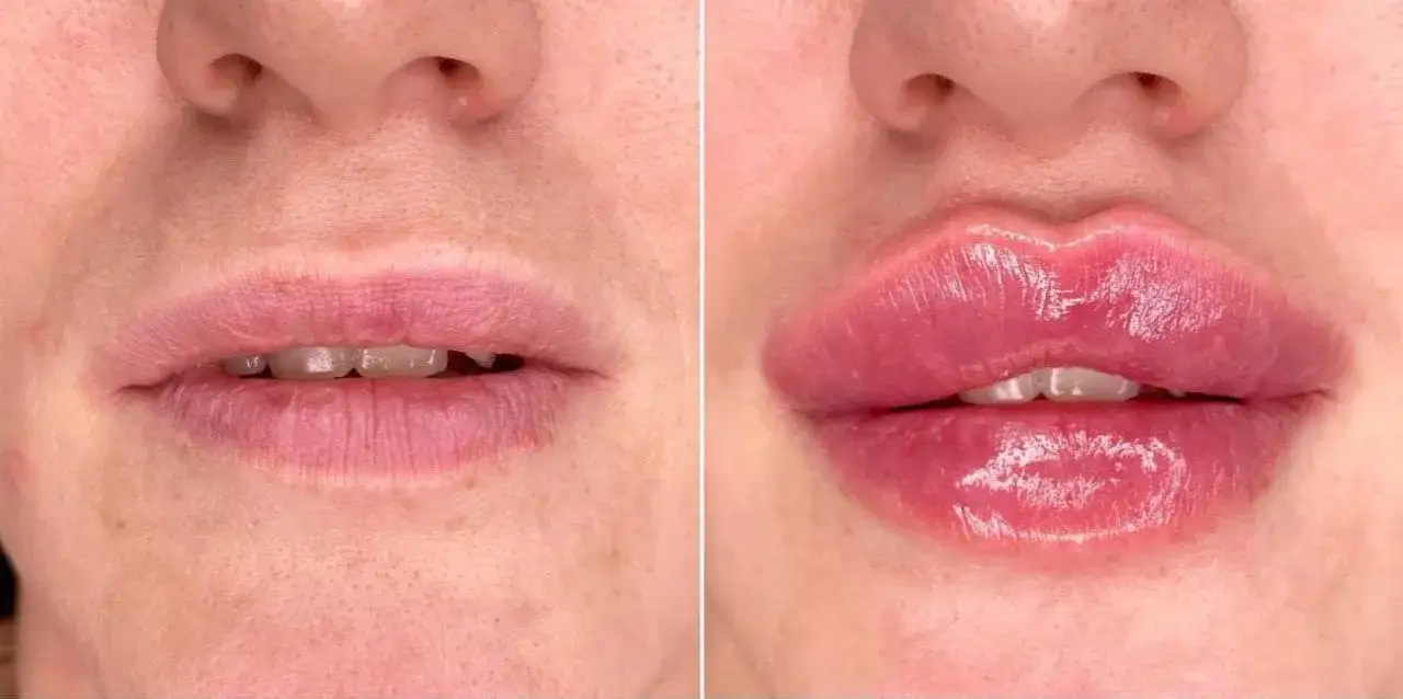 Czy po powiększaniu ust można palić? Skutki dla zdrowia i gojenia