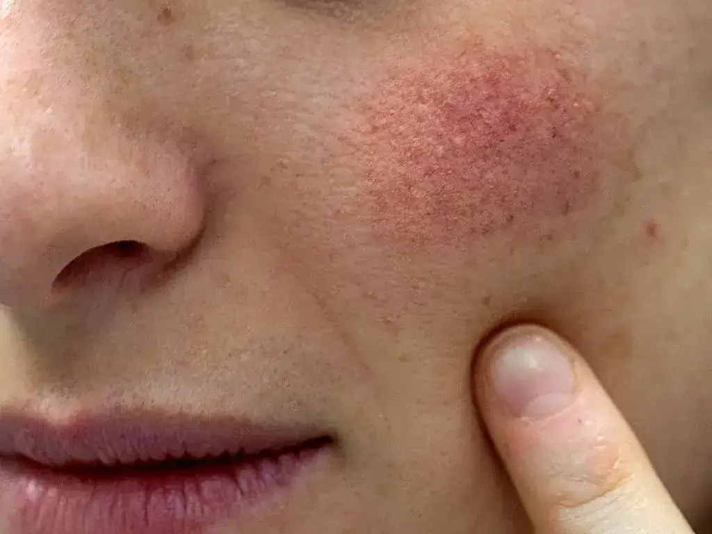 Czerwone ślady po pryszczach: Jak pozbyć się PIE i odzyskać gładką skórę?