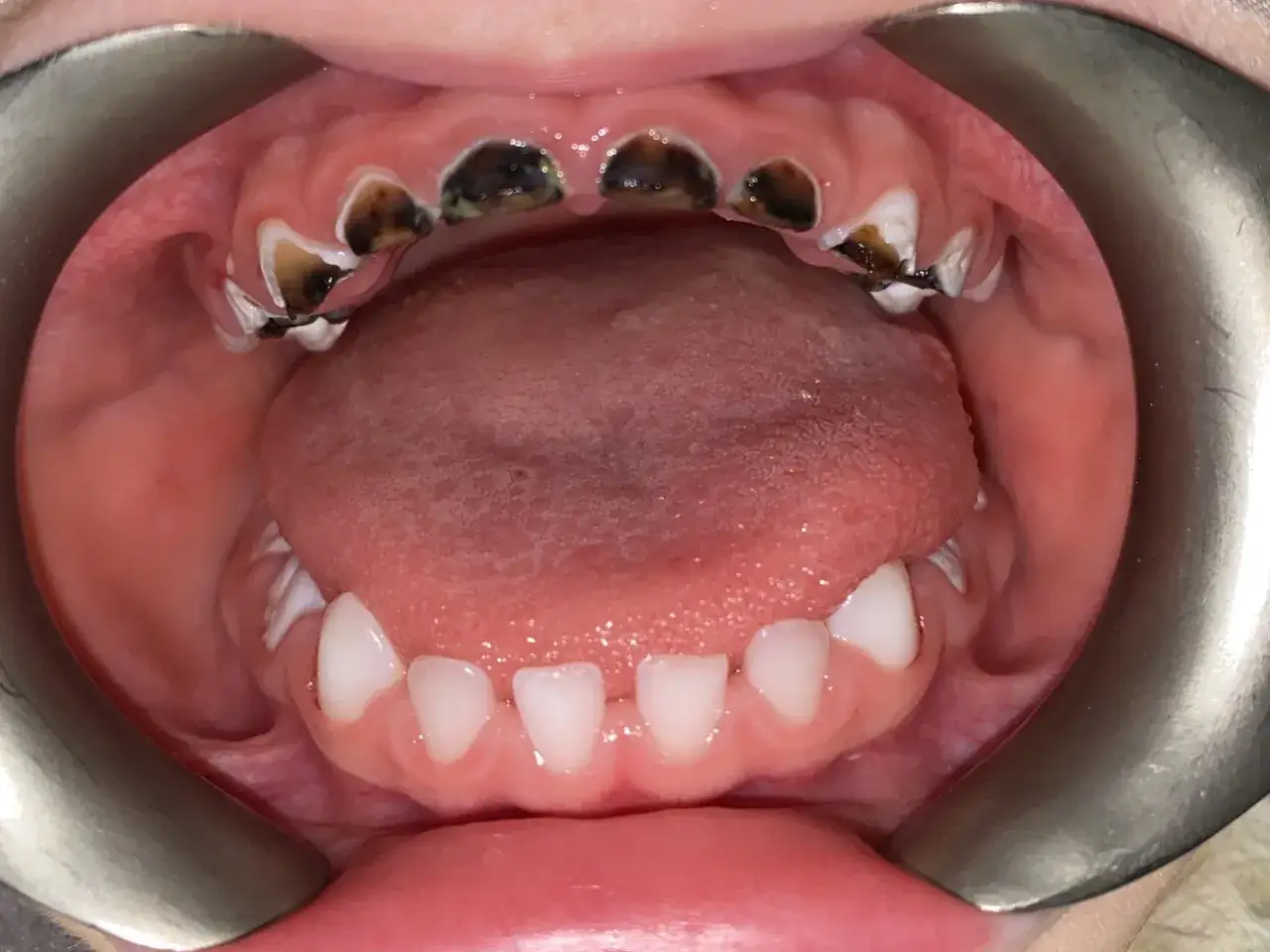 Ząb mleczny z próchnicą: Leczyć to priorytet! Kiedy ekstrakcja?