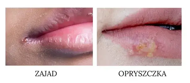 Zajady: Skuteczne leki, przyczyny i jak się ich pozbyć