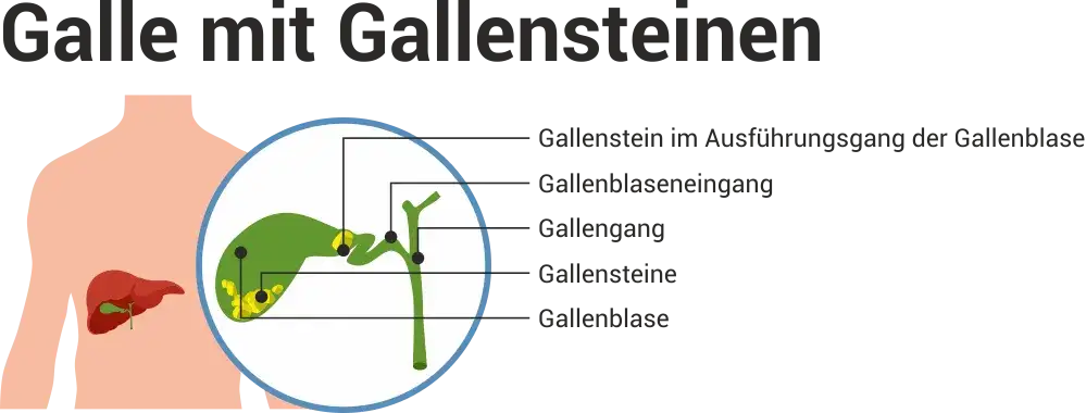Verstopfte Gallengänge: Symptome erkennen & Ursachen verstehen