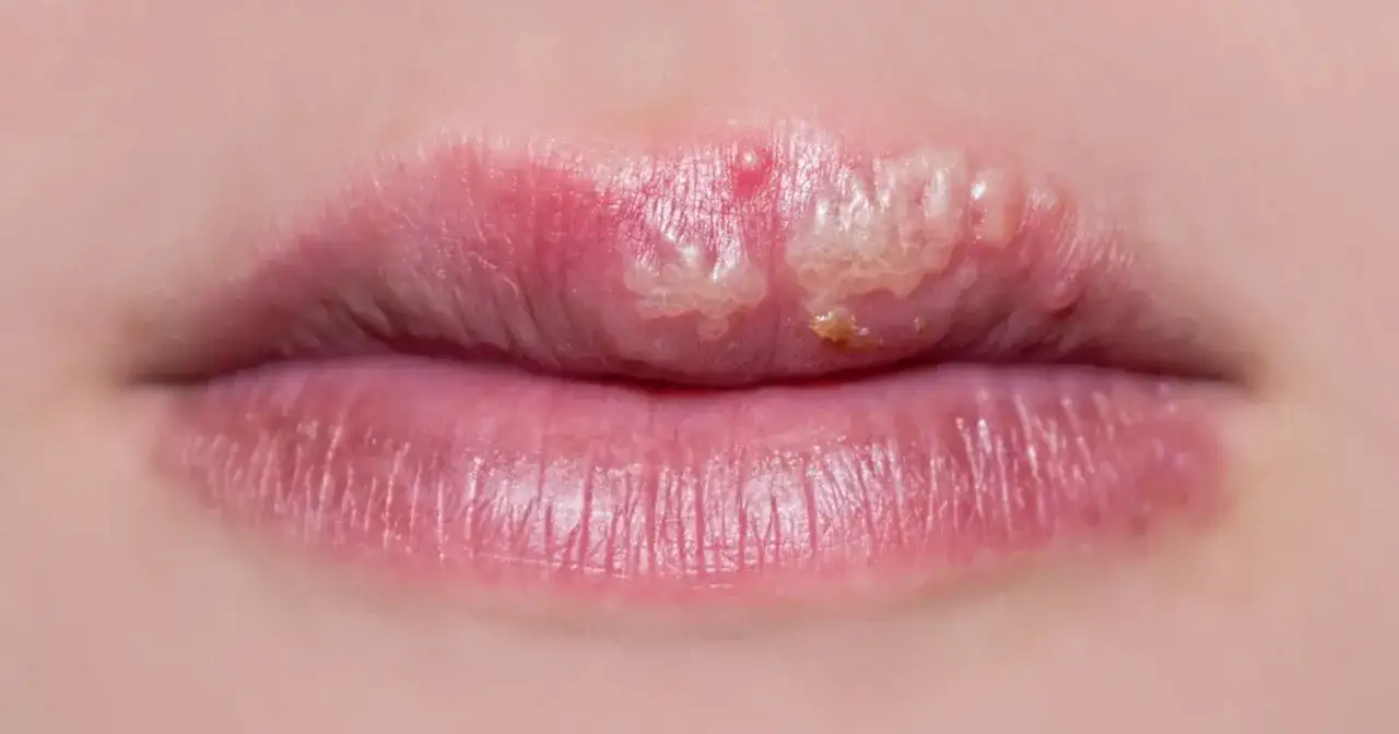 Widoczne pęcherzyki i zaczerwienienie na ustach, objawy opryszczki.