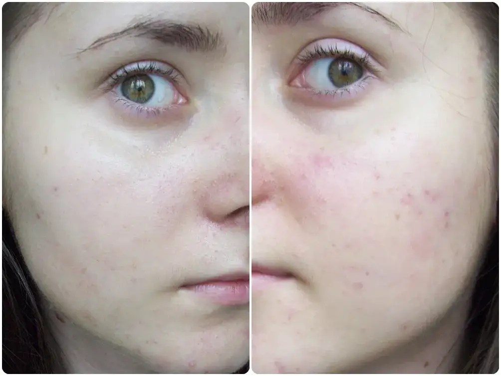 Kwas azelainowy – Zastosowanie, opinie i efektywność dla skóry